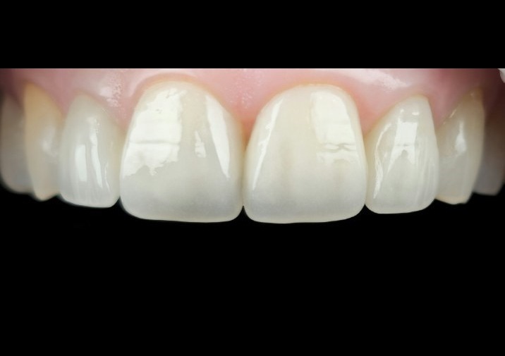After — ceramic crowns, smile view