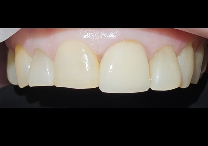 Before — ceramic crowns, smile view