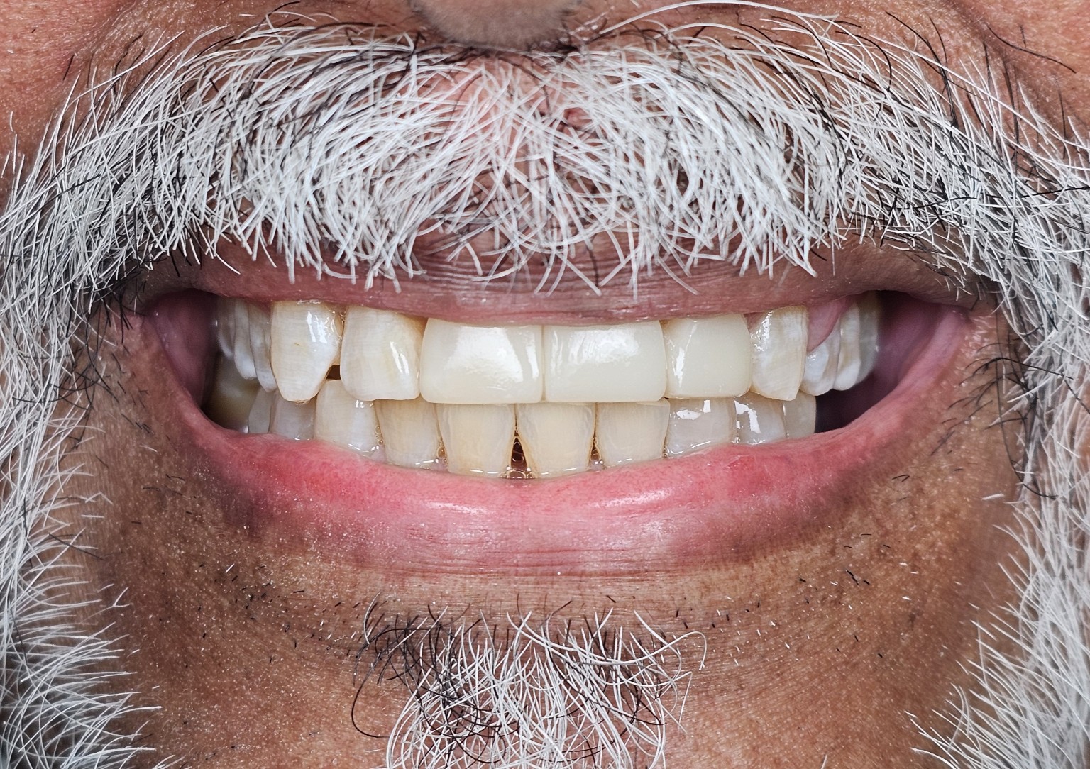 After — direct composite bridge, smile view