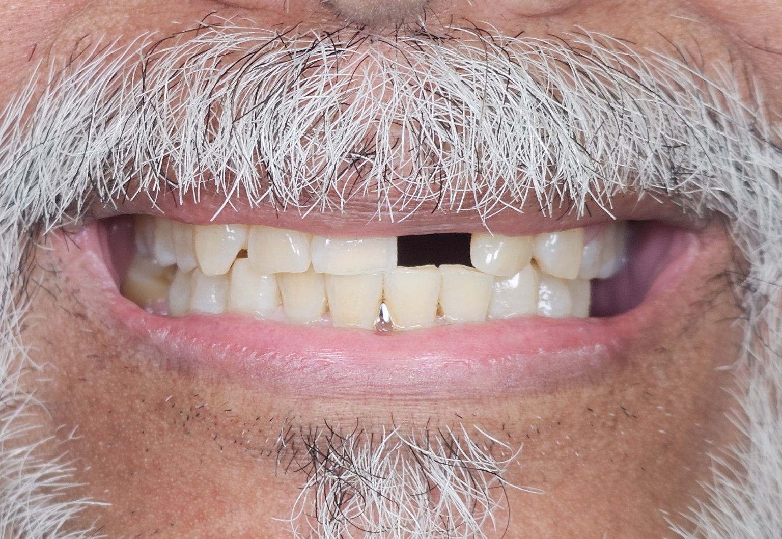 Before — direct composite bridge, smile view