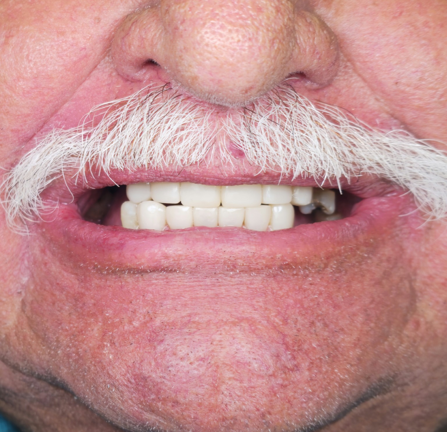 After — direct composite rehabilitation, smile view