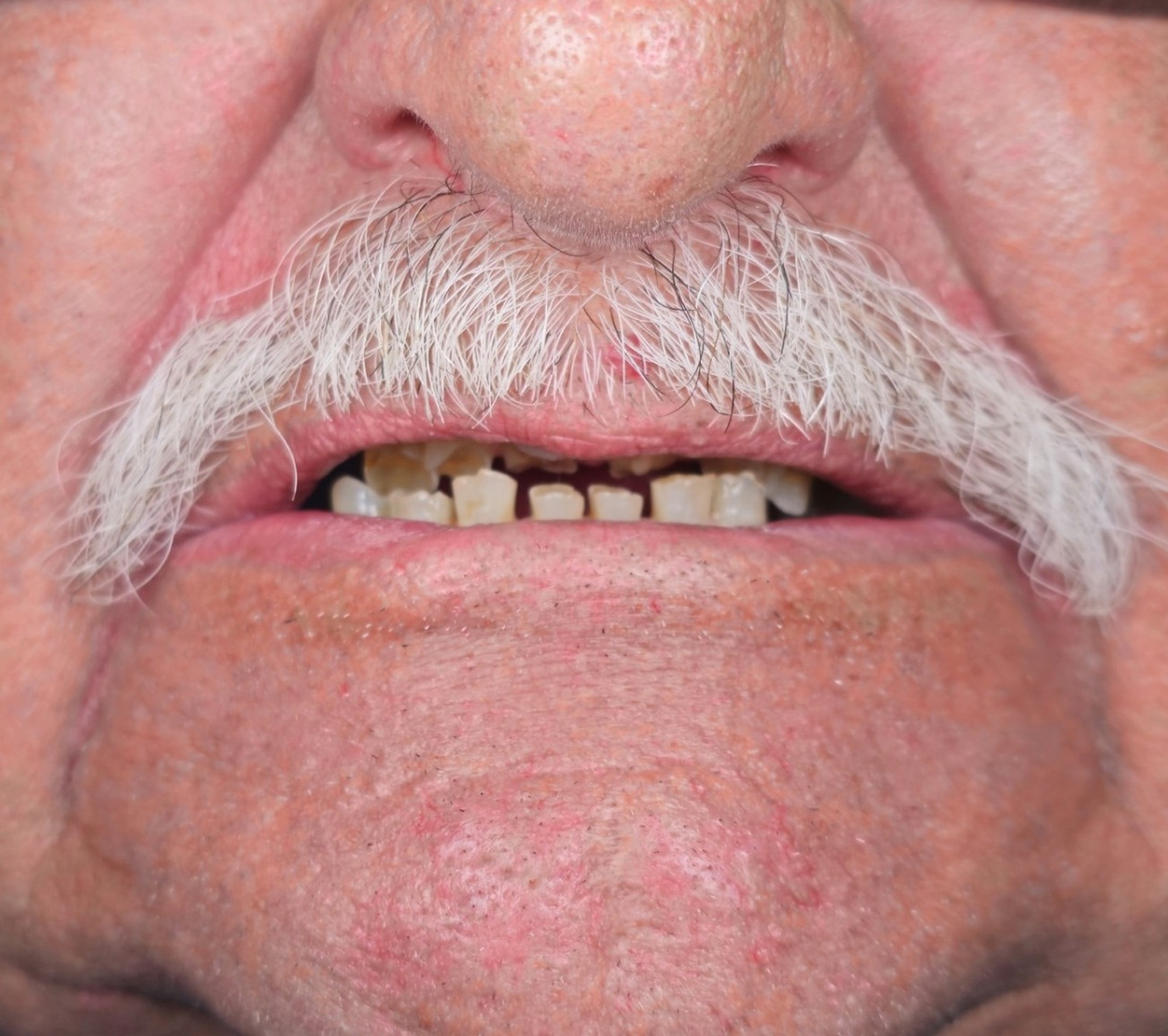 Before — direct composite rehabilitation, smile view
