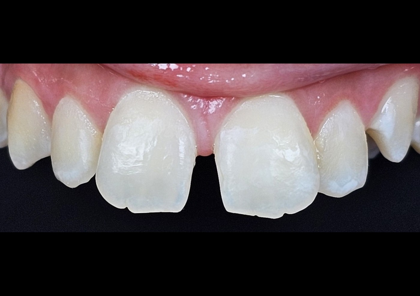 After — non-invasive stain improvement, smile view