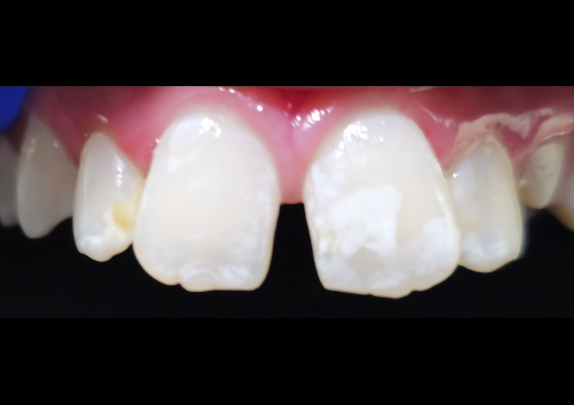 Before — non-invasive stain improvement, smile view